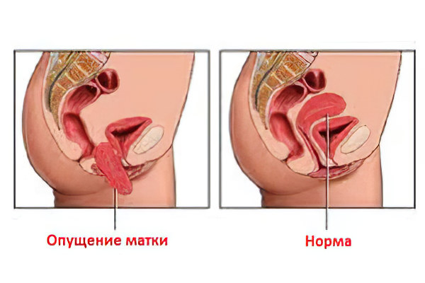 Как Выглядит Опущение Матки Фото