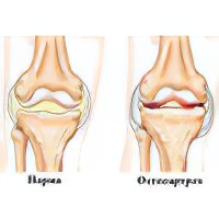 Как вылечить остеоартроз голеностопного сустава