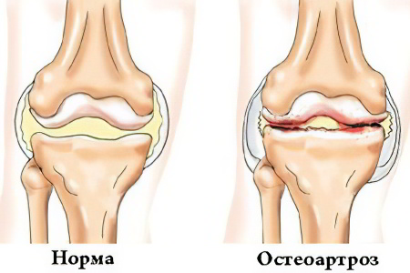 остеоартроз