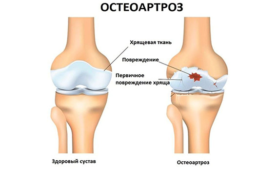 Остеоартроз