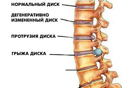 остеохондроз