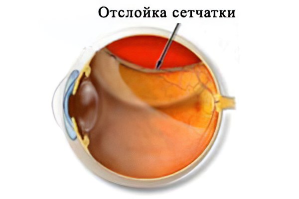 Отслоение сетчатки глаза