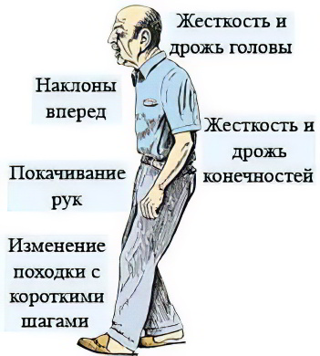 болезнь Паркинсона