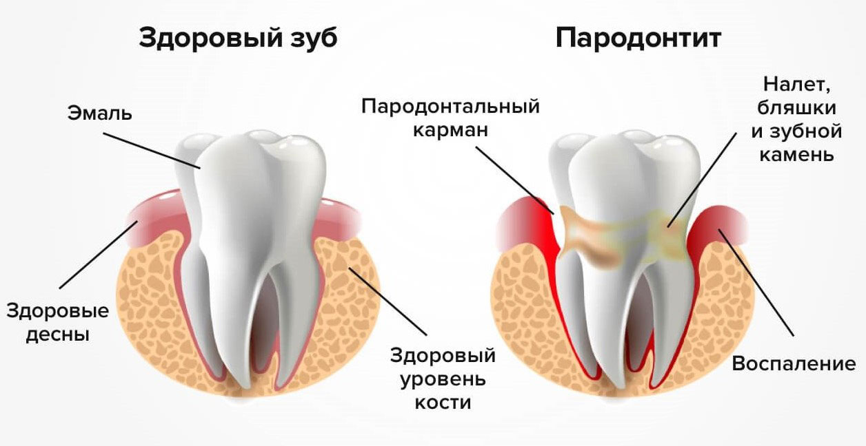 Пародонтит