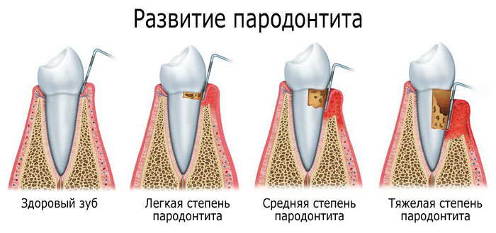 Степени пародонтита