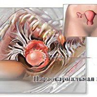 Фолликулярная киста как вылечить народные средства