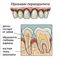 Зубные отеки чем лечить