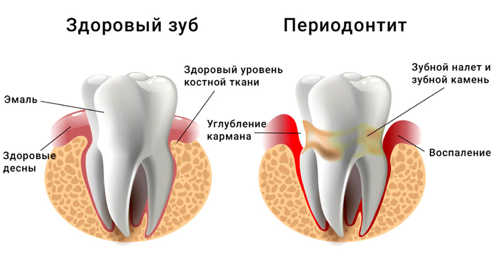 Периодонтит