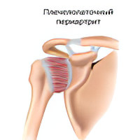 Изображение - Периартрит коленного сустава лечение plecheopatochnii_periatrit7