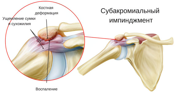 Субакромиальный синдром столкновения