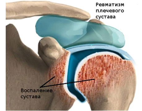 Аутоиммунные заболевания