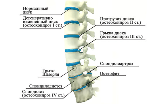 Болезни позвоночника