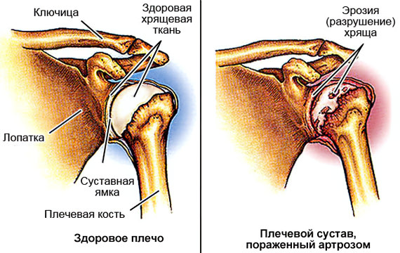 Артроз плечевого сустава