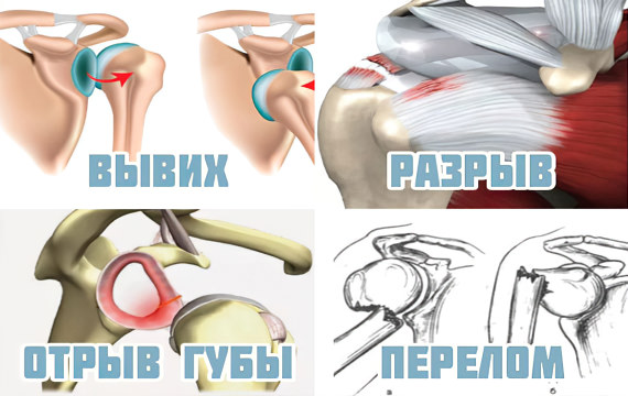 Вывих, разрывы, отрыв губы, перелом