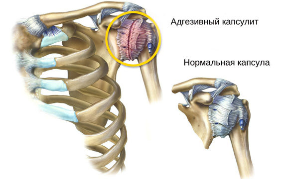 Адгезивный капсулит