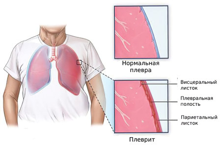 Заболевания респираторной системы