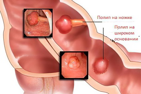 полипы