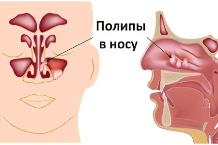 полипы