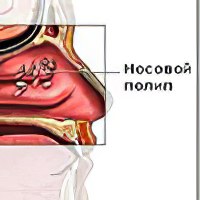 Полипы в носу