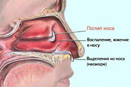 Полипозный гайморит