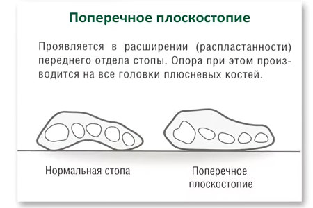 Поперечное плоскостопие