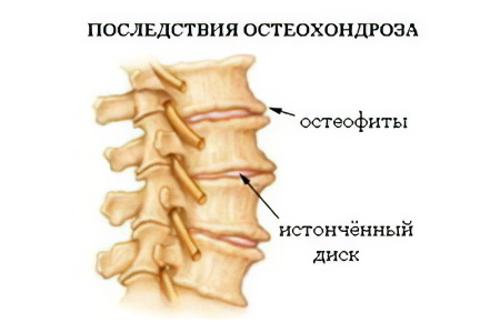 Последствия остеохондроза