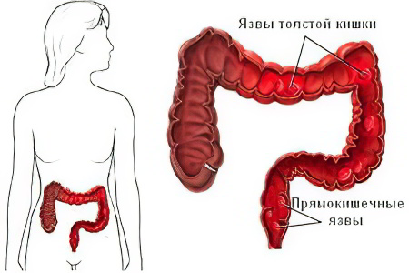 колит