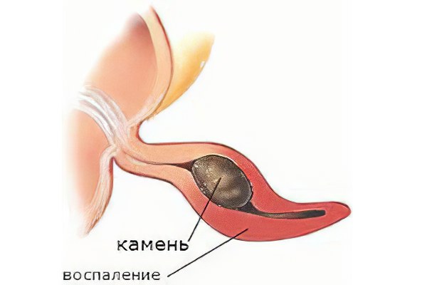 Причины аппендицита