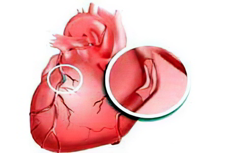 Причины ишемии сердца