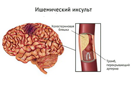 Причины инсульта