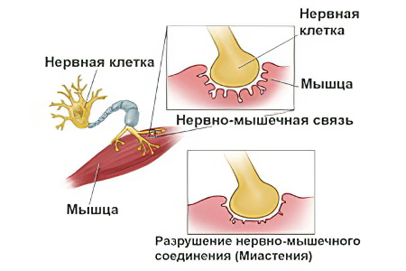 Причины миастении