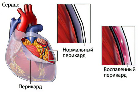 Причины перикардита