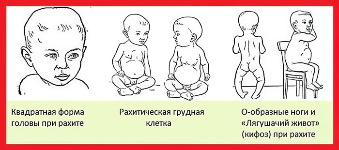 Признаки дефицита у детей Признаки дефицита у детей