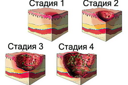 Пролежни