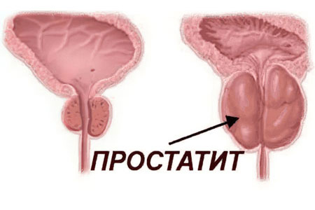 din prostatita sulfa p