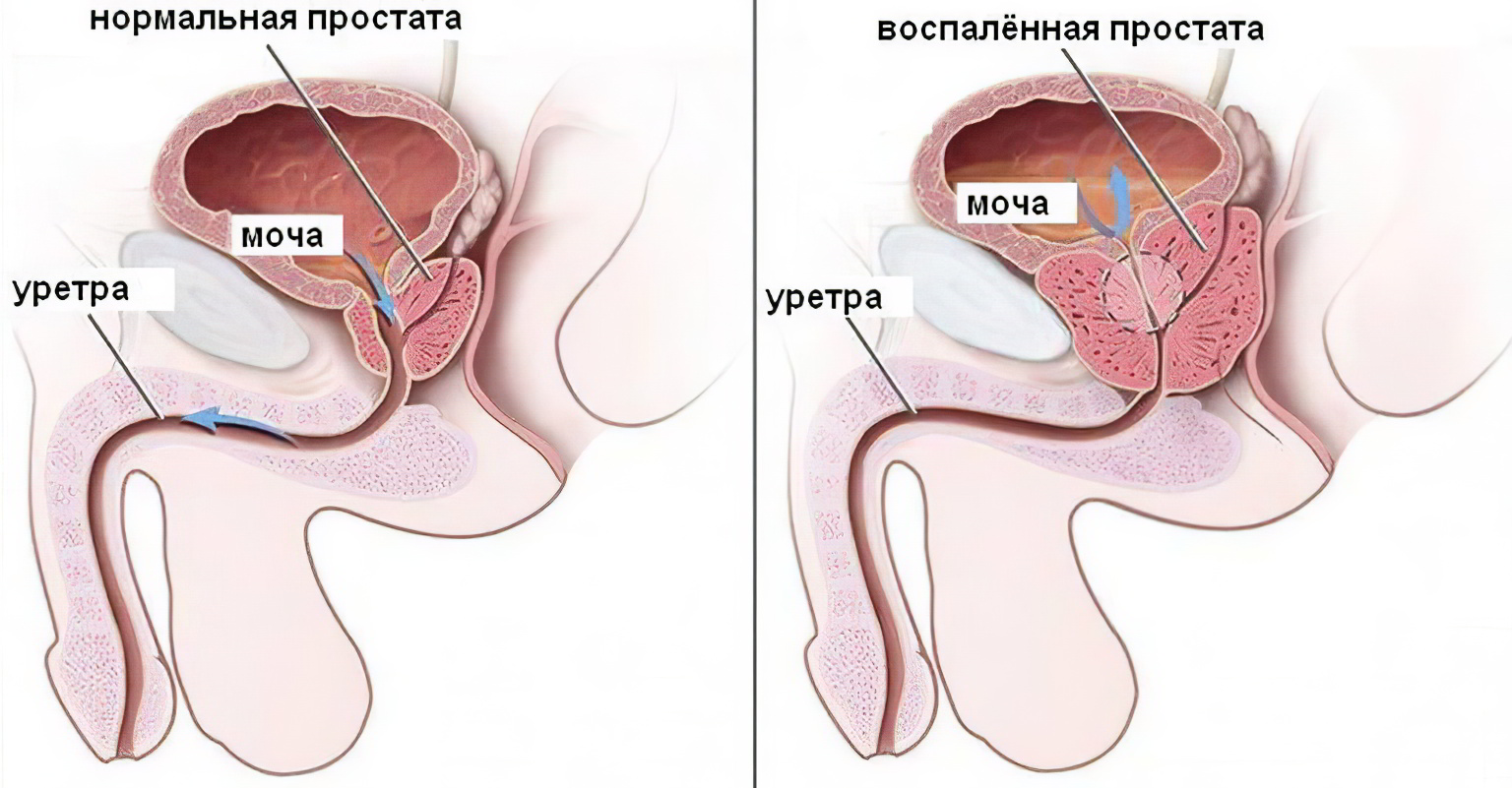 Что такое простатит Что такое простатит