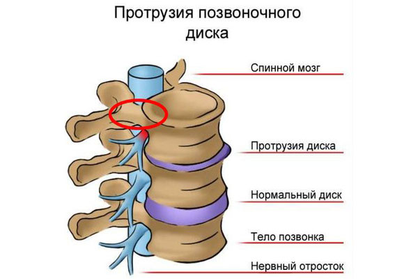 Протрузия дисков