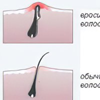 Советы для лечения волос от выпадения
