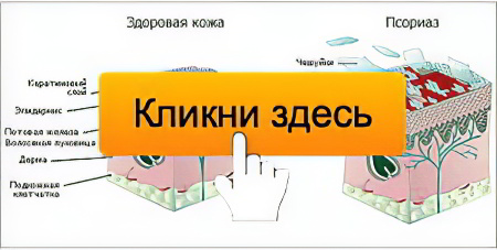 Псориаз Псориаз