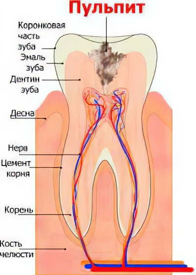 пульпит пульпит