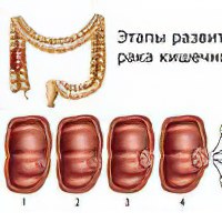 Больной после операции рака желудка