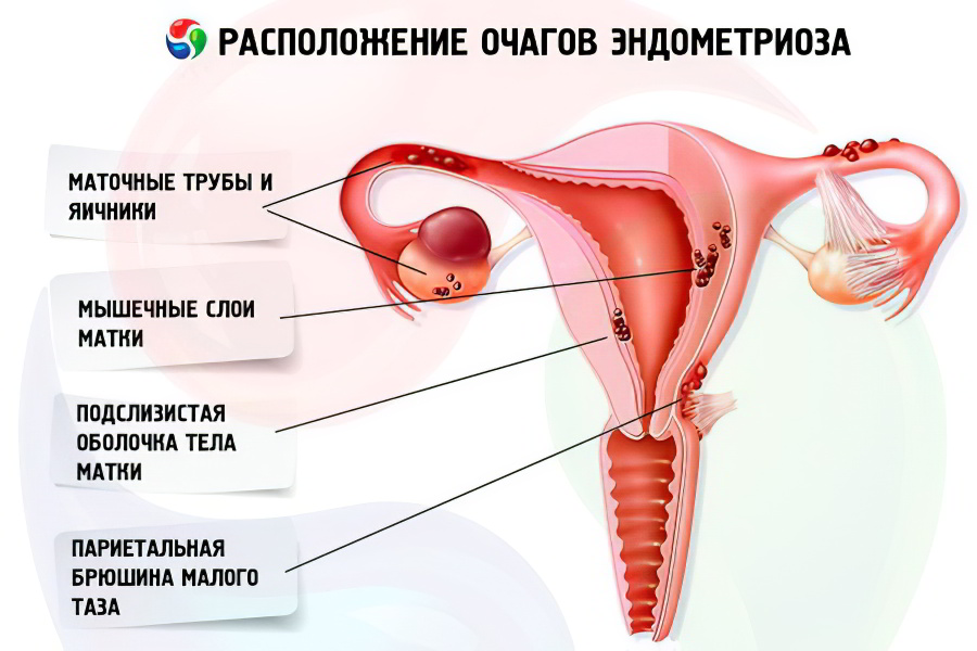 Эндометриоз матки