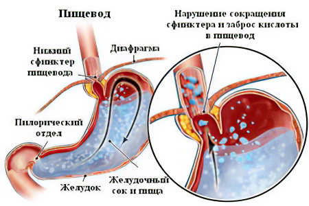 Рефлюкс-эзофагит