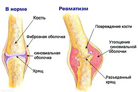 ревматизм