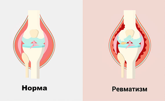 Ревматизм