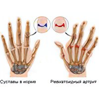 Ревматоидный артрит