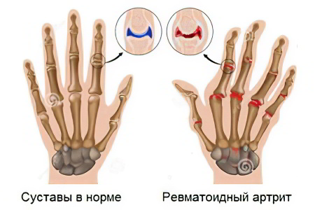 Ревматоидный артрит