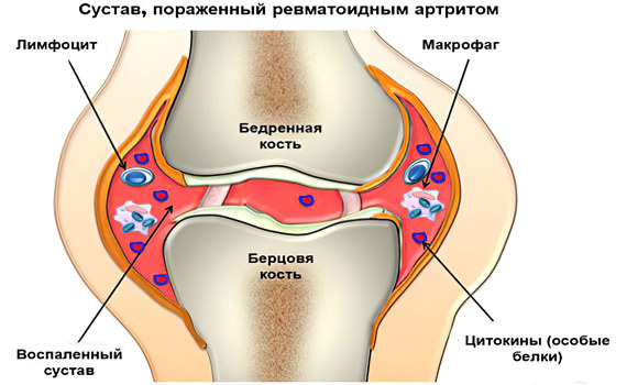 Ревматоидный артрит