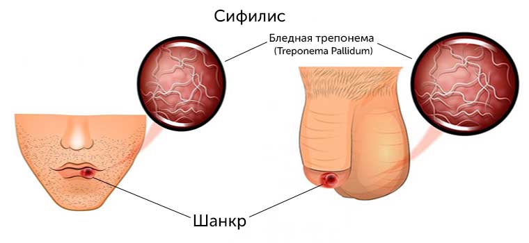 Трепонема и шанкр при сифилисе