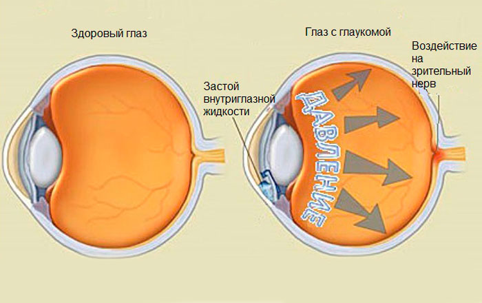 Виды глауком